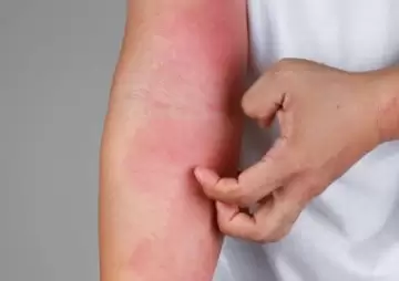 Dermatites e Homeopatia