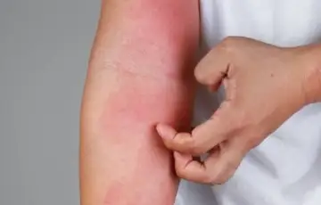 Dermatites e Homeopatia